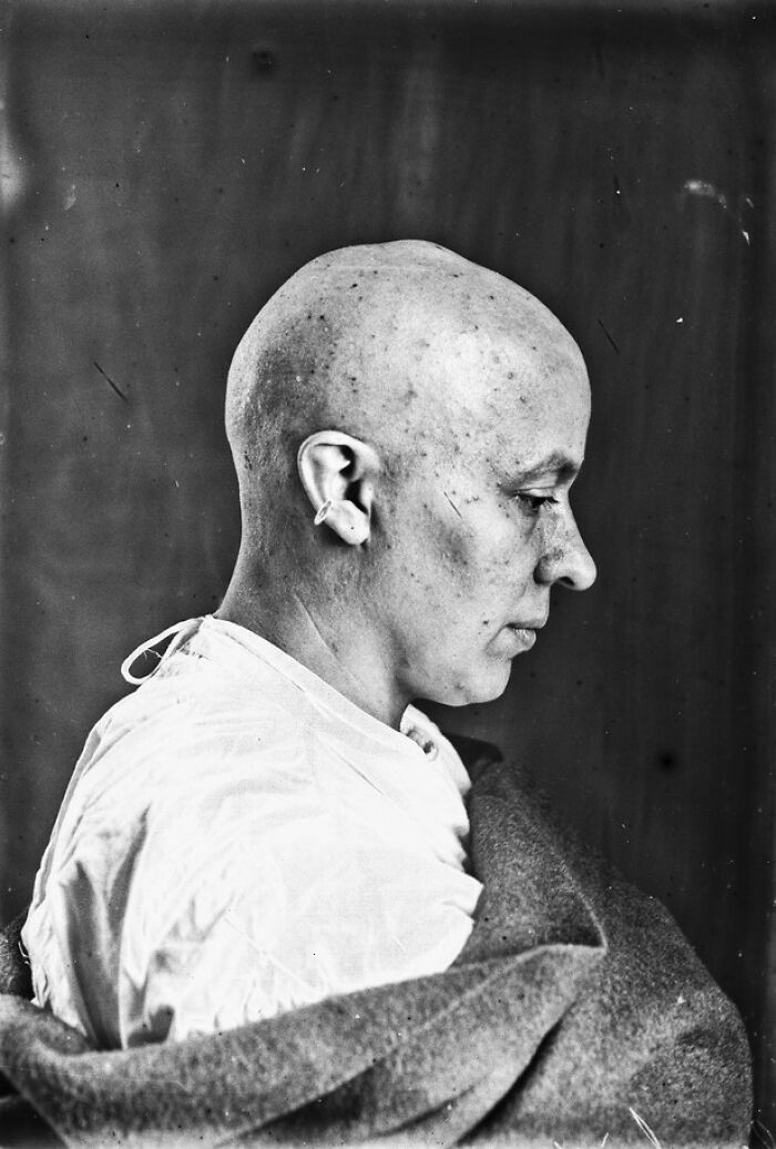 Surgery Patients Of Dr. Harvey Cushing