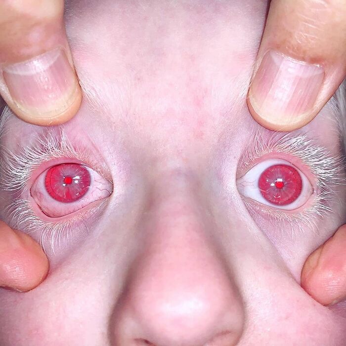 Ocular Albinism Is A Genetic Condition That Primarily Affects The Eyes