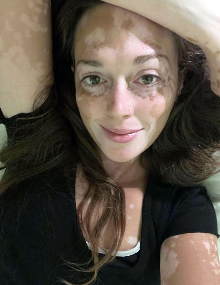 Calling For All Fellow Vitiligo Owners - You Need To Start Embracing The Unique Beauty Of Our Condition. Don't Let Your Life Suffer When Others Have No Choice In The Matter. Keep Smiling