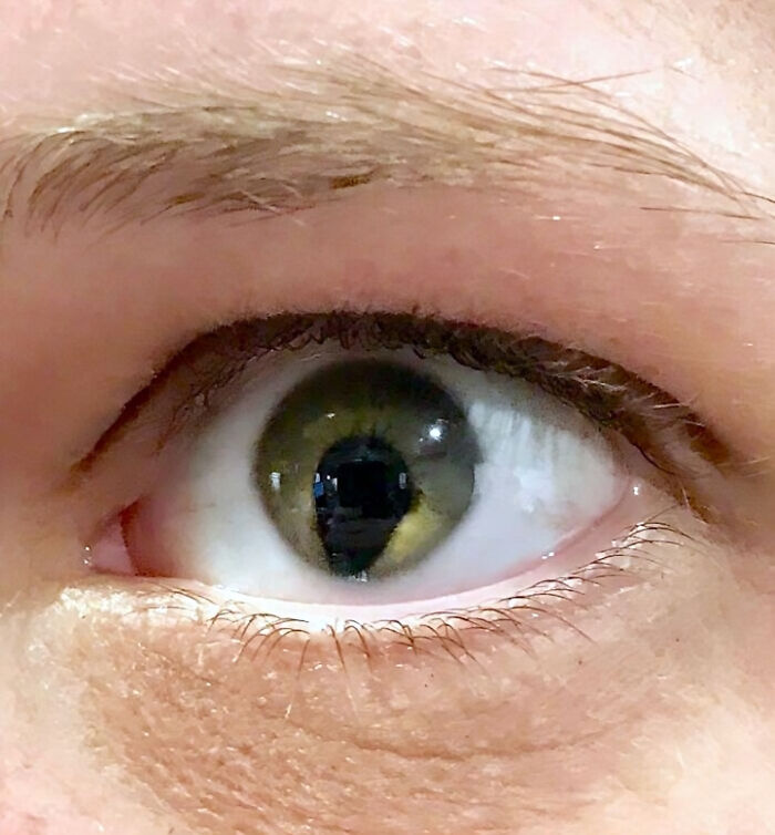 I Have A Coloboma - A Hole In The Structure Of The Eye