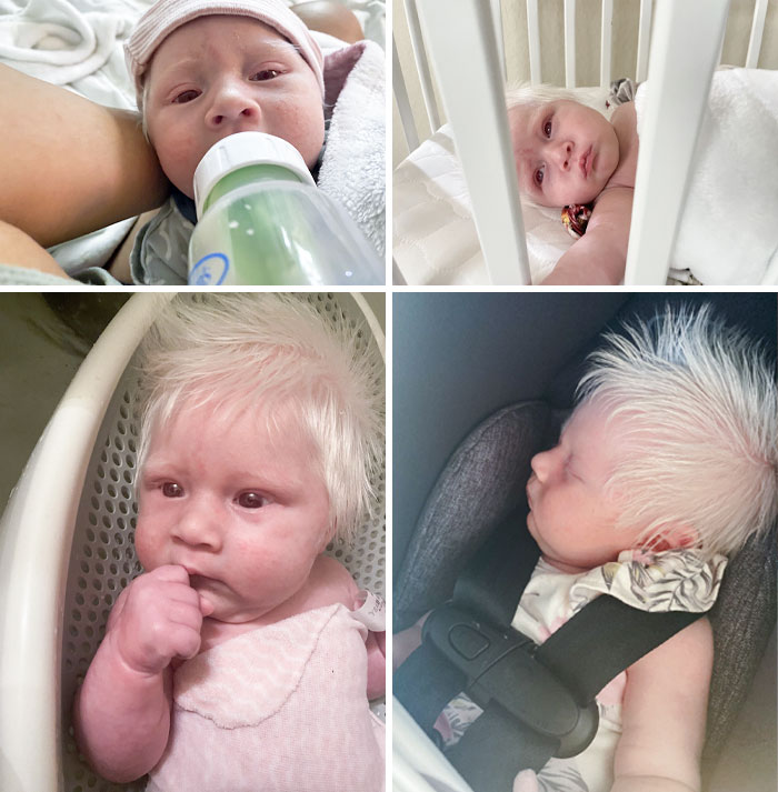 My Little Girl Was Born With Albinism, And She Is So Beautiful