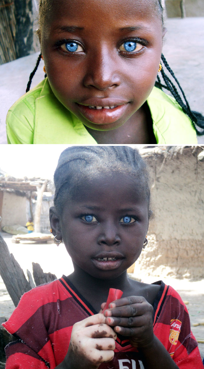 Stunning Blue Eyes. A Girl With Waardenburg Syndrome
