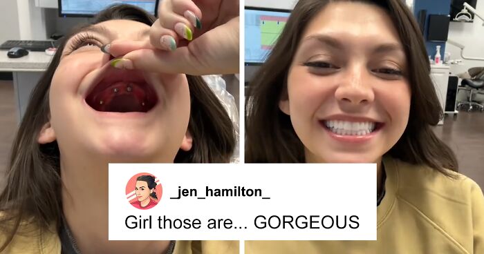 After Having All Her Teeth Pulled Out At 20, Woman Shares “Before/After” Implants Transformation
