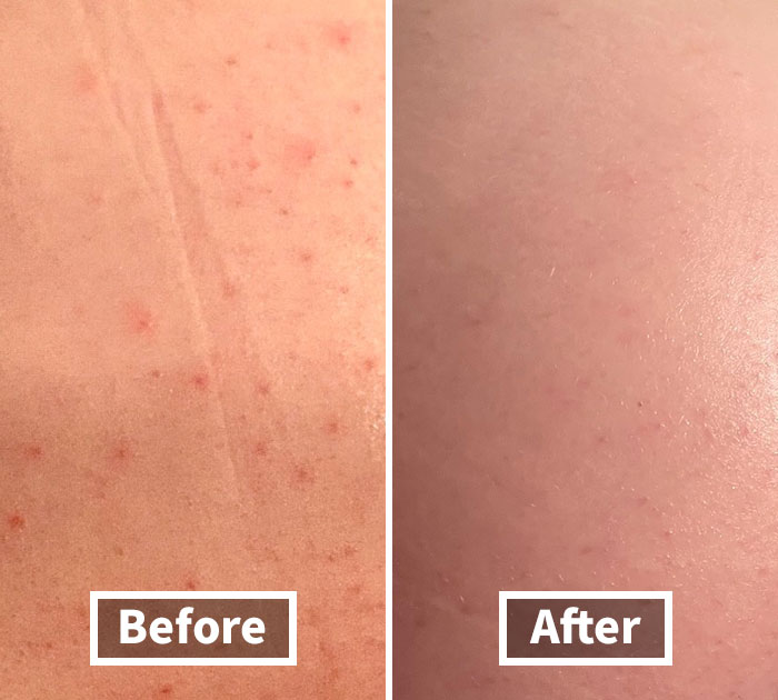 Say Bye To Blemishes: Rock A Bump-Free Booty With Butt Acne Clearing Lotion!