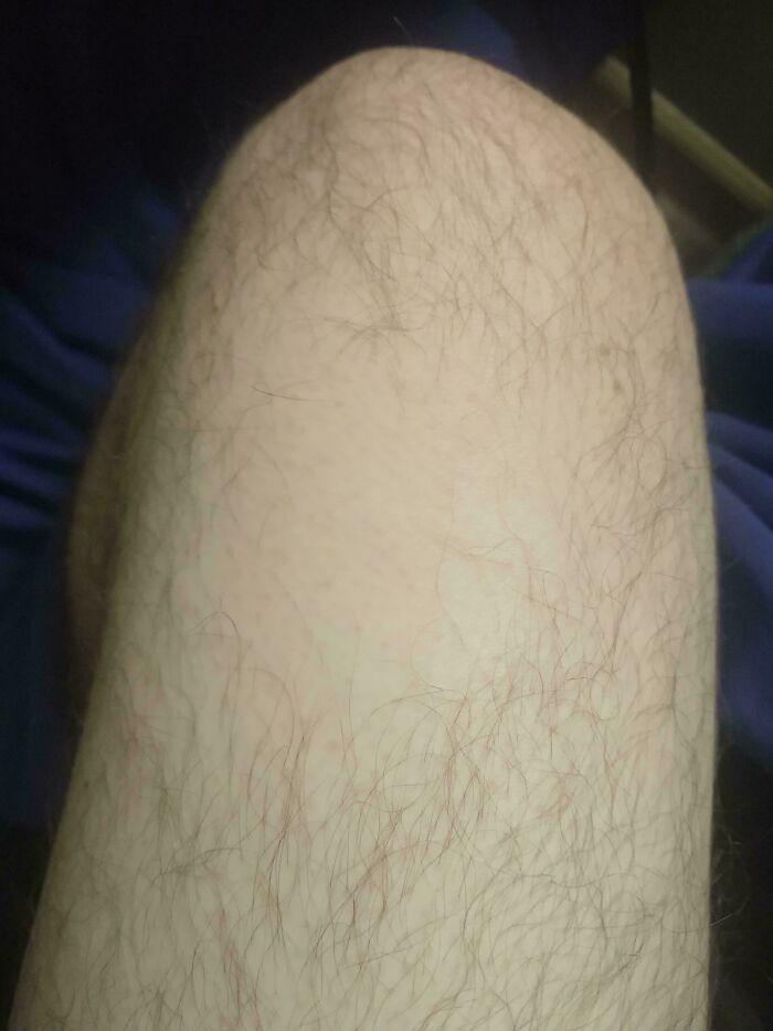 Saw A Post About Goose Bumps After Surgery, Here's The Spot They Temporarily Paralyzed My Nerve For A Lower Leg Surgery. No Hair For Years