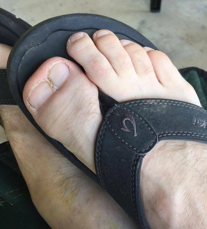 Buddy Of Mine Has A Double Big Toe. Yes, He Plays Soccer