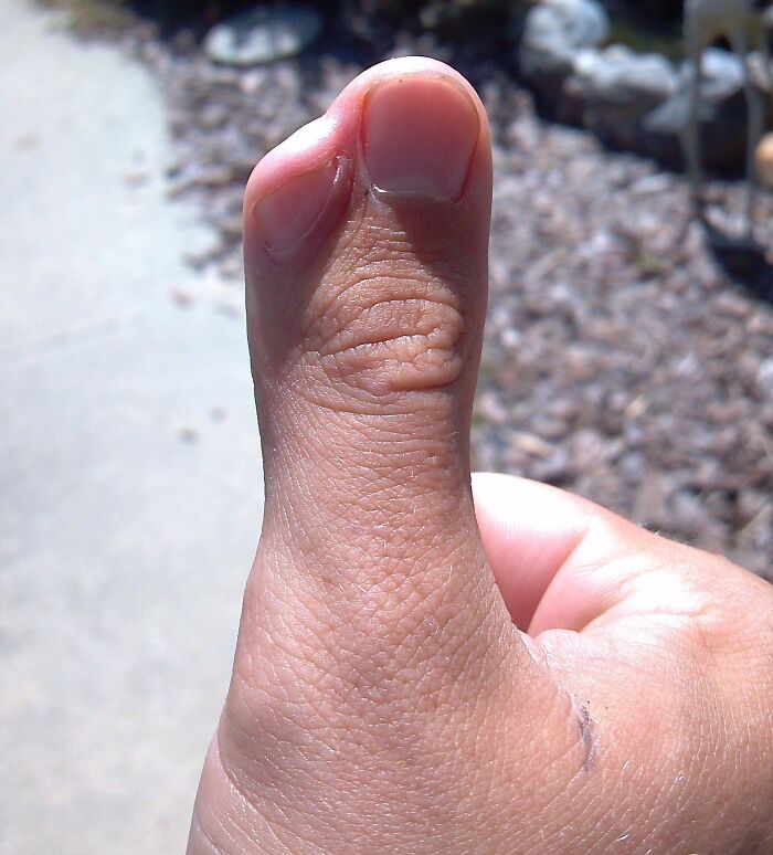 I See Your Extra Toe And Raise You My Extra Thumb