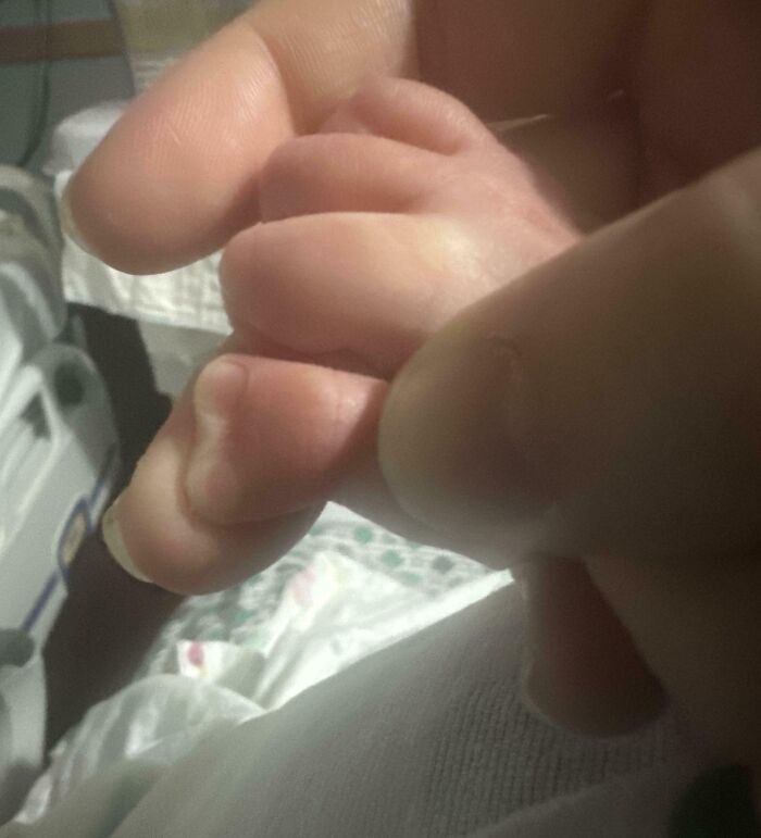 My Newborn Son Was Born With A Heart-Shaped Thumb