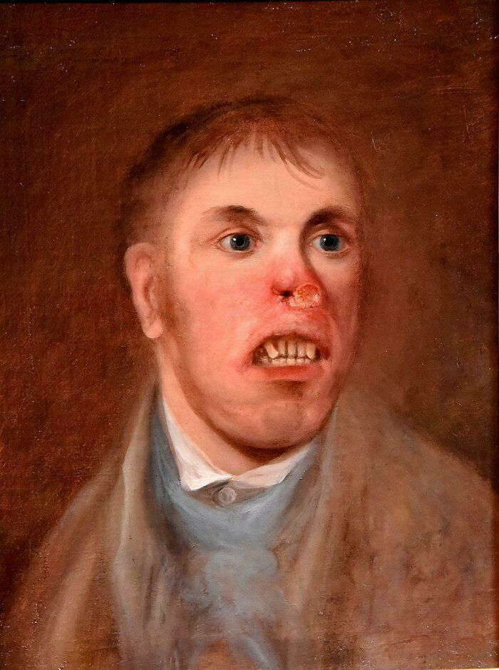 Portrait Of A Man Affected With What Is Now Believed To Have Been Congenital Syphilis C. 1820
