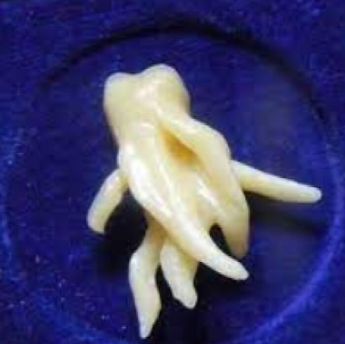 Apparently, This Was Someone's Wisdom Tooth: