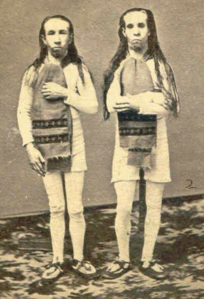 The “Wild Men Of Borneo” Were Underdeveloped Twins That Were Actually Sold To Circus By Their Own Mother - 1874 (More Info In The Comments)