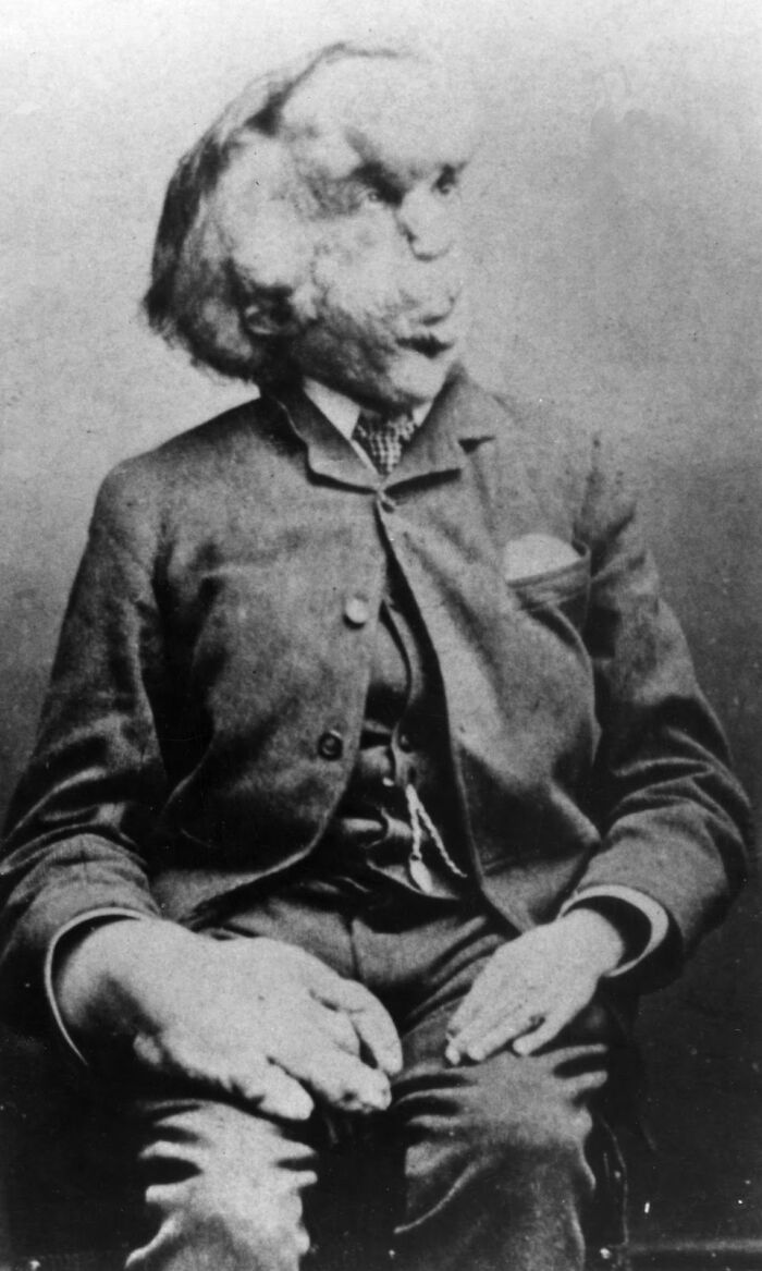 Photo Of Joseph Merrick (The Elephant Man) Circa 1889