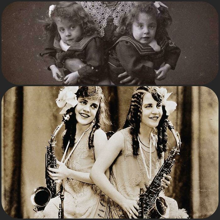 The Hilton Sisters: Violet (Left) & Daisy (Right). Conjoined Twins And Entertainers, Born In England During The Early 1900’s