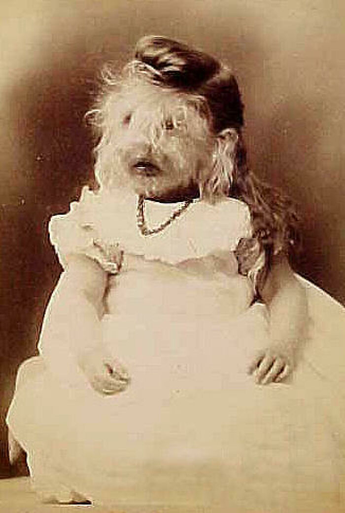 Til About Alice Elizabeth Doherty Who Is The Only Known Person To Have Suffered From Hypertrichosis (Werewolf Syndrome) In The Us. She Was Exhibited As A Sideshow Attraction By Her Parents