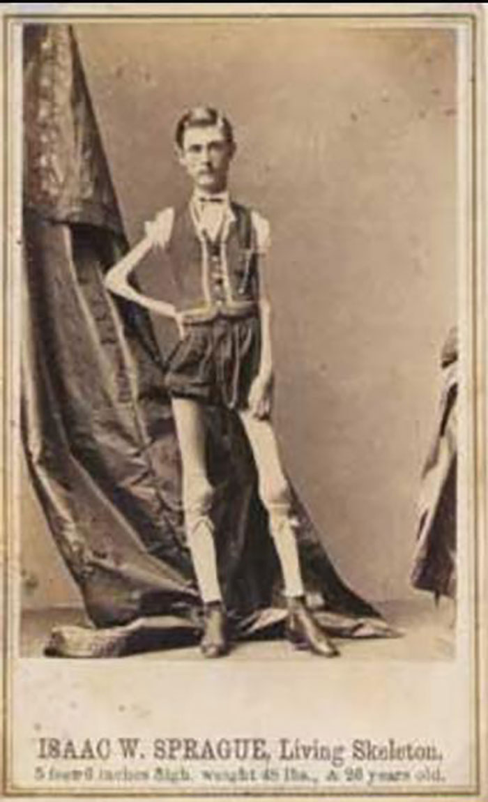 Isaac W. Sprague (May 21, 1841 - January 5, 1887) Was An Entertainer And Sideshow Performer, Billed As The Living Human Skeleton