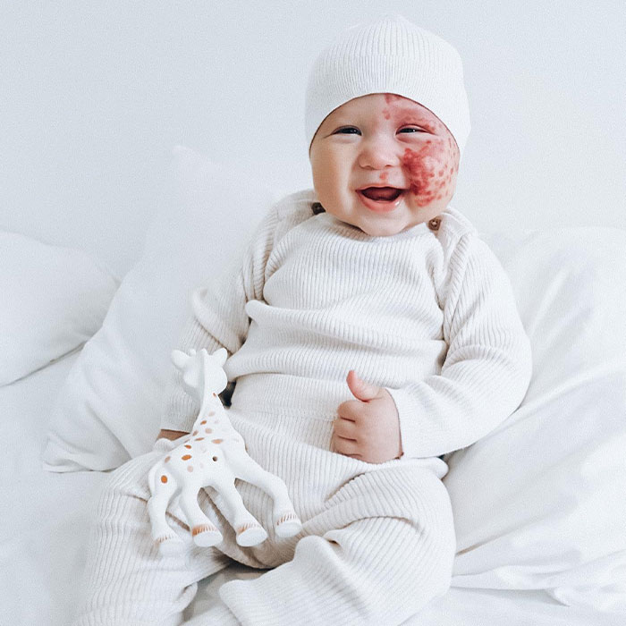 Trolls Called This Mom A “Monster” For Lasering Off Son’s Birthmark—Now She’s Making A Difference Trolls Called This Mom A “Monster” For Lasering Off Son’s Birthmark—Now She’s Making A Difference