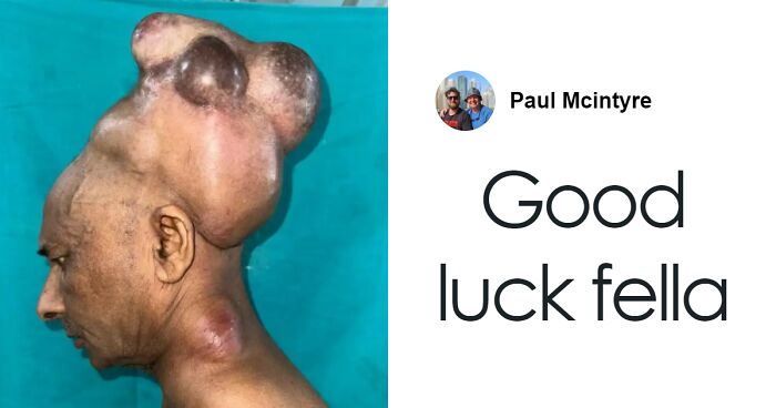 Surgeons Finally Remove 15-Lb Tumor From Man’s Scalp After 25 Years