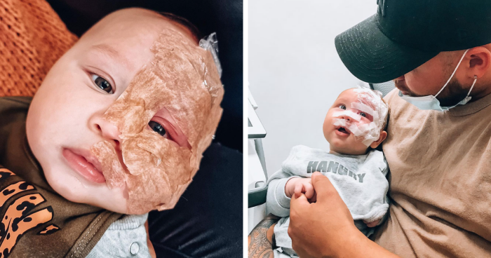 Mom Who Was Called A “Monster” For Removing Baby’s Port-Wine Birthmark Is Now Making A Difference