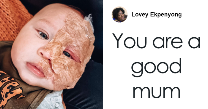 Trolls Called This Mom A “Monster” For Lasering Off Son’s Birthmark—Now She’s Making A Difference