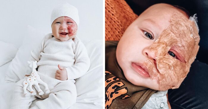 Trolls Called Her A “Monster” For Lasering Off Son’s Birthmark—Now She’s Making A Difference
