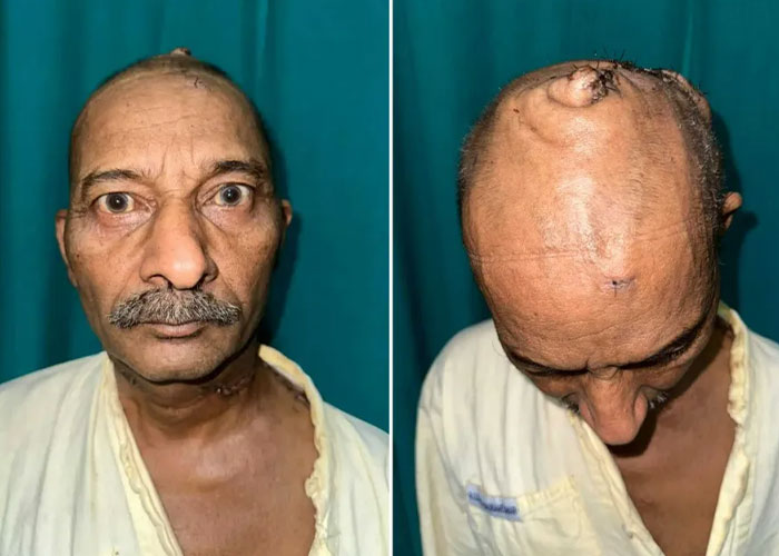 Surgeons Finally Remove 15-Lb Tumor From Man’s Scalp After 25 Years