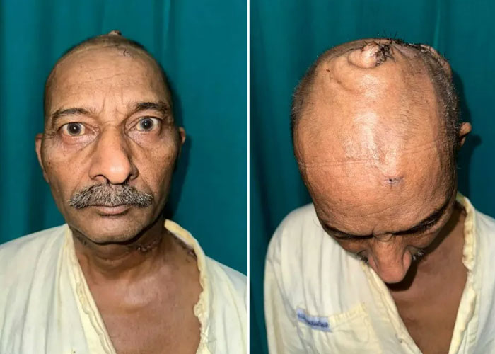 Surgeons Finally Remove 15-Lb Tumor From Man’s Scalp After 25 Years Surgeons Finally Remove 15-Lb Tumor From Man’s Scalp After 25 Years