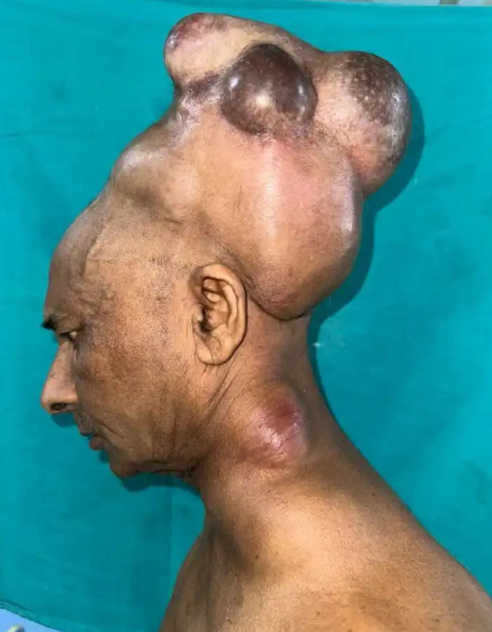 Surgeons Finally Remove 15-Lb Tumor From Man’s Scalp After 25 Years