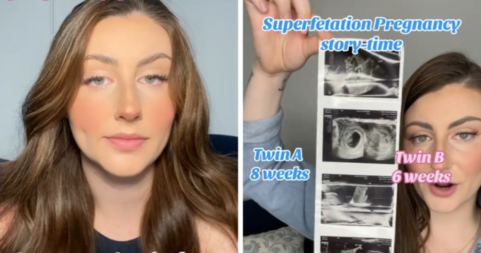 Health Professionals Stunned By Mother’s “Superfetation” Pregnancy
