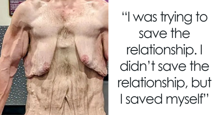 Man Raises $76k To Surgically Remove Excess Skin After Huge Weight-Loss Transformation