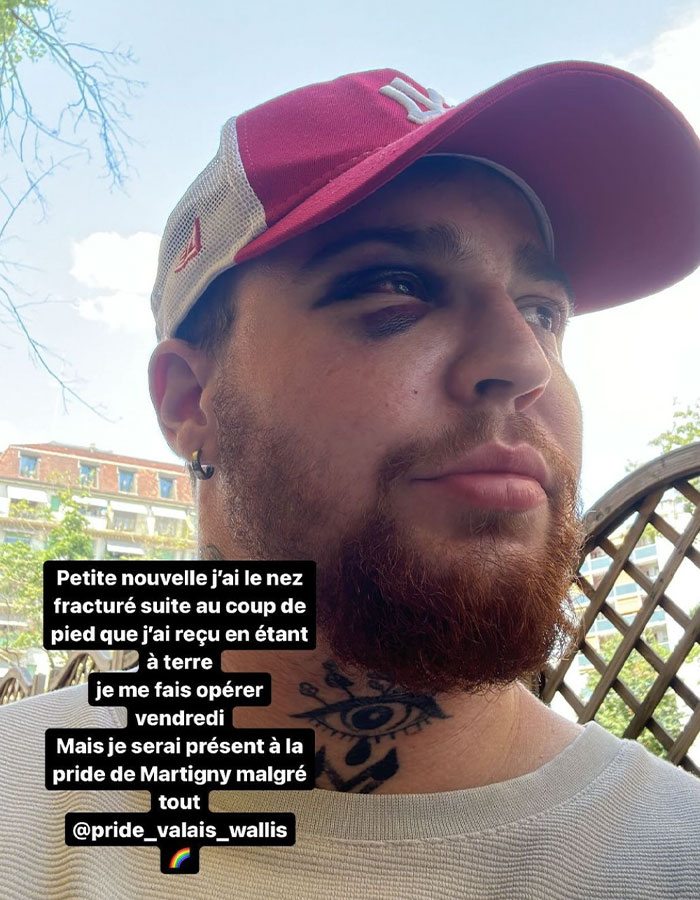 29-Year-Old Trans Man Gets Brutally Beaten Up In Switzerland, Claims It’s A Hate Crime 29-Year-Old Trans Man Gets Brutally Beaten Up In Switzerland, Claims It’s A Hate Crime