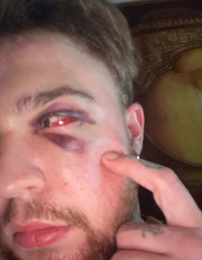 29-Year-Old Trans Man Gets Brutally Beaten Up In Switzerland, Claims It’s A Hate Crime 29-Year-Old Trans Man Gets Brutally Beaten Up In Switzerland, Claims It’s A Hate Crime