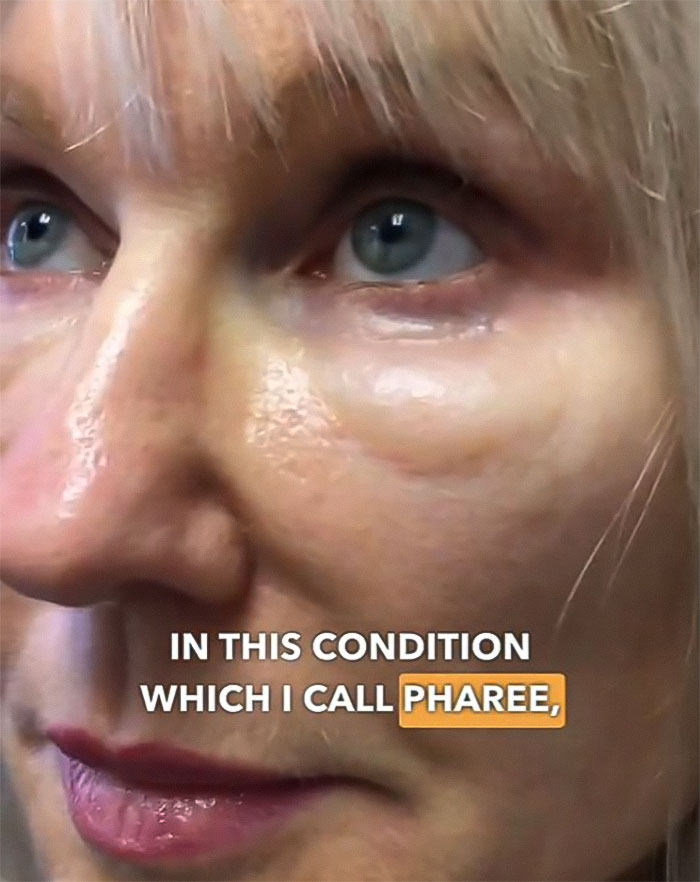 “Never Getting Fillers”: After MRI Of Woman Stuns Viewers, Doctor Discusses Effects “Never Getting Fillers”: After MRI Of Woman Stuns Viewers, Doctor Discusses Effects