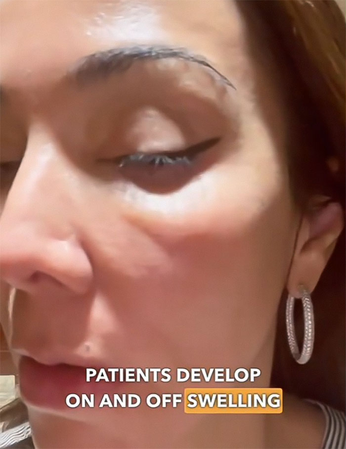 “Never Getting Fillers”: After MRI Of Woman Stuns Viewers, Doctor Discusses Effects “Never Getting Fillers”: After MRI Of Woman Stuns Viewers, Doctor Discusses Effects