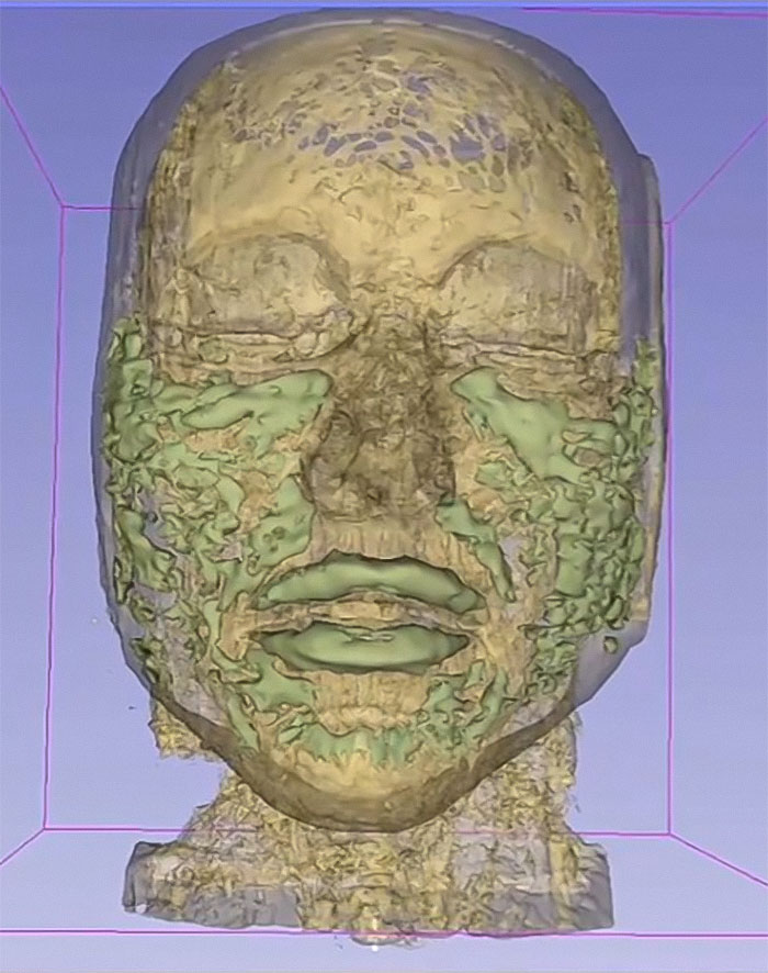 “Never Getting Fillers”: After MRI Of Woman Stuns Viewers, Doctor Discusses Effects “Never Getting Fillers”: After MRI Of Woman Stuns Viewers, Doctor Discusses Effects