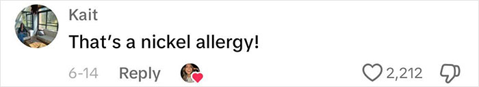 Woman Realizes She’s Been “Accidentally Poisoning” Herself For Months After Removing Earrings Woman Realizes She’s Been “Accidentally Poisoning” Herself For Months After Removing Earrings