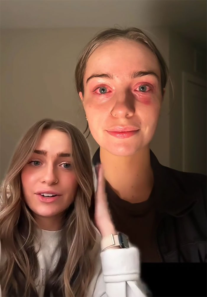 Woman Realizes She’s Been “Accidentally Poisoning” Herself For Months After Removing Earrings Woman Realizes She’s Been “Accidentally Poisoning” Herself For Months After Removing Earrings