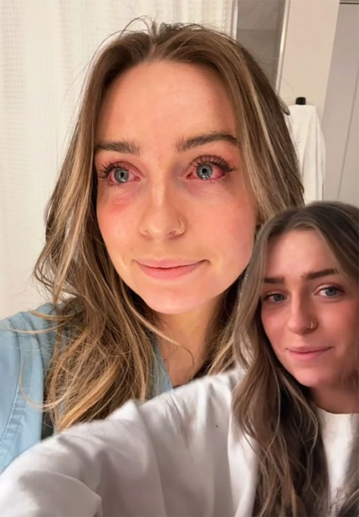 Woman Realizes She’s Been “Accidentally Poisoning” Herself For Months After Removing Earrings Woman Realizes She’s Been “Accidentally Poisoning” Herself For Months After Removing Earrings