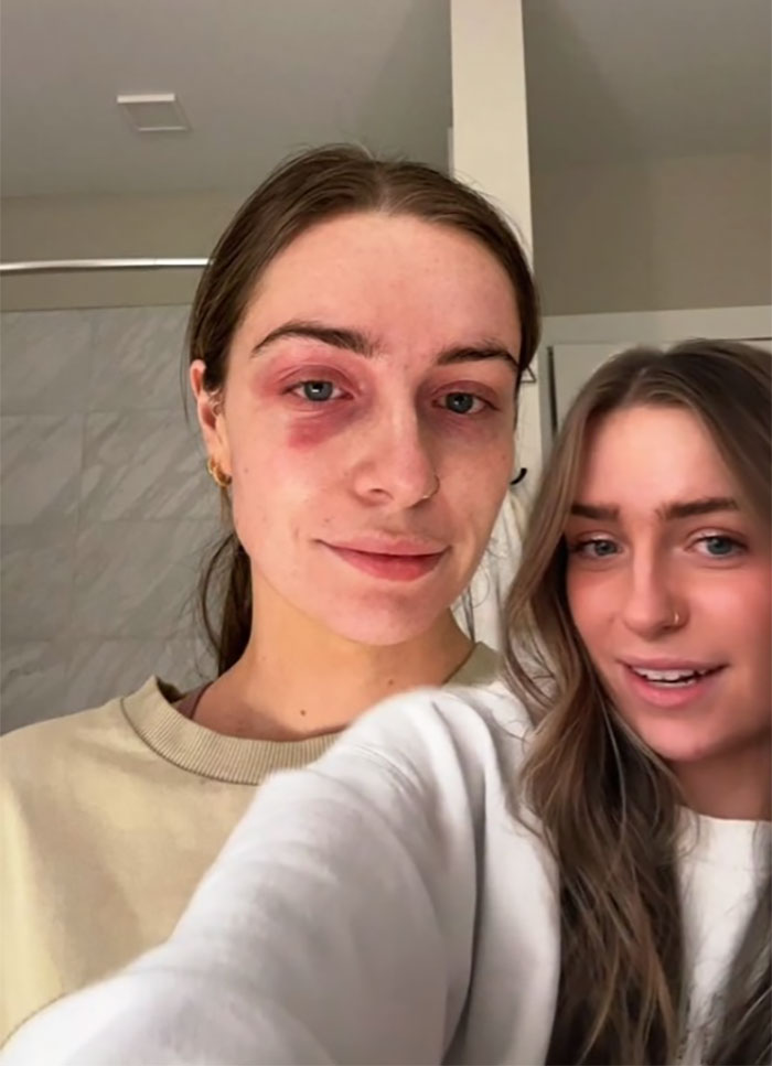 Woman Realizes She’s Been “Accidentally Poisoning” Herself For Months After Removing Earrings Woman Realizes She’s Been “Accidentally Poisoning” Herself For Months After Removing Earrings