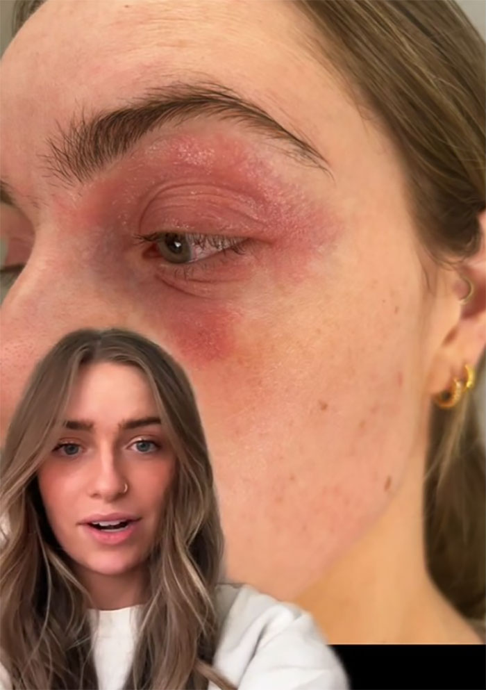 Woman Realizes She’s Been “Accidentally Poisoning” Herself For Months After Removing Earrings Woman Realizes She’s Been “Accidentally Poisoning” Herself For Months After Removing Earrings