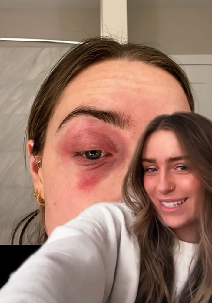 Woman Realizes She’s Been “Accidentally Poisoning” Herself For Months After Removing Earrings Woman Realizes She’s Been “Accidentally Poisoning” Herself For Months After Removing Earrings