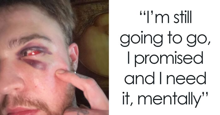 Close-up of a 29-year-old trans man with a black eye and bruises, highlighting a reported hate crime incident.