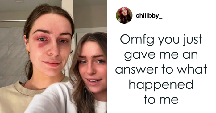 Woman Realizes She’s Been “Accidentally Poisoning” Herself For Months After Removing Earrings