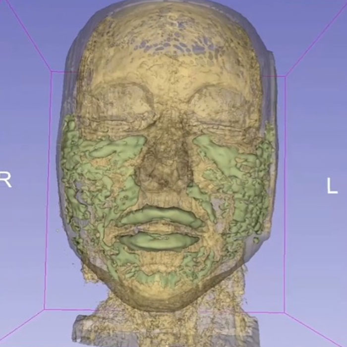MRI Of 33-Year-Old Woman’s Face Reveals Where All Her Filler Went MRI Of 33-Year-Old Woman’s Face Reveals Where All Her Filler Went