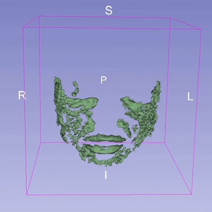 MRI Of 33-Year-Old Woman’s Face Reveals Where All Her Filler Went MRI Of 33-Year-Old Woman’s Face Reveals Where All Her Filler Went
