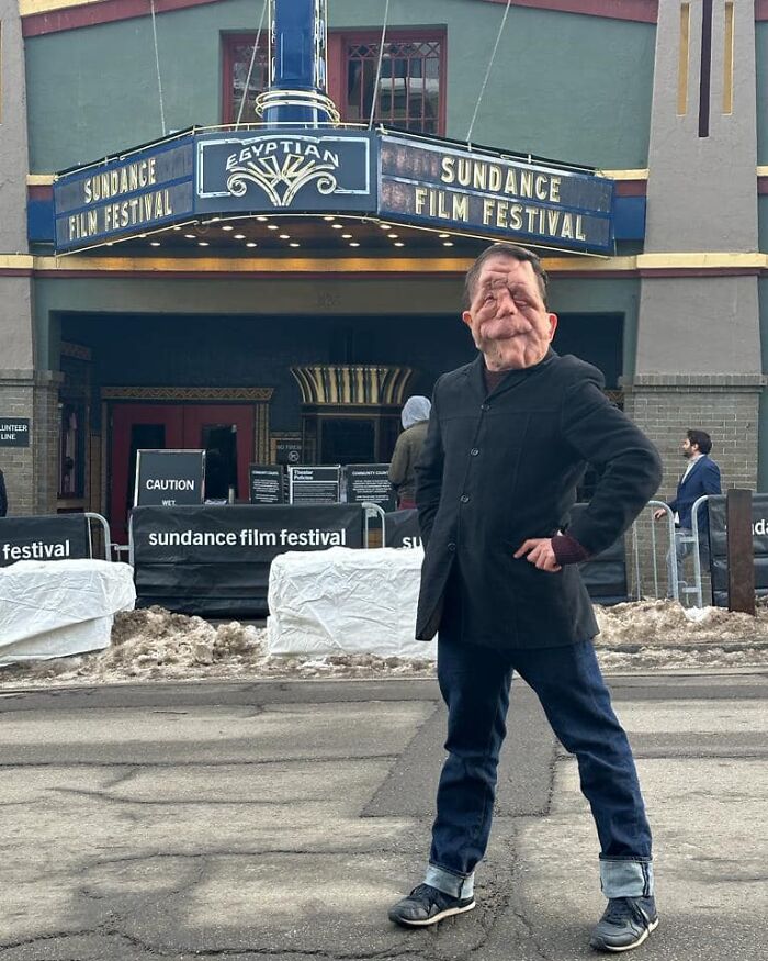 “My Disability Has Opened Doors”: Actor Adam Pearson Wants To Normalize Facial Disfigurement “My Disability Has Opened Doors”: Actor Adam Pearson Wants To Normalize Facial Disfigurement