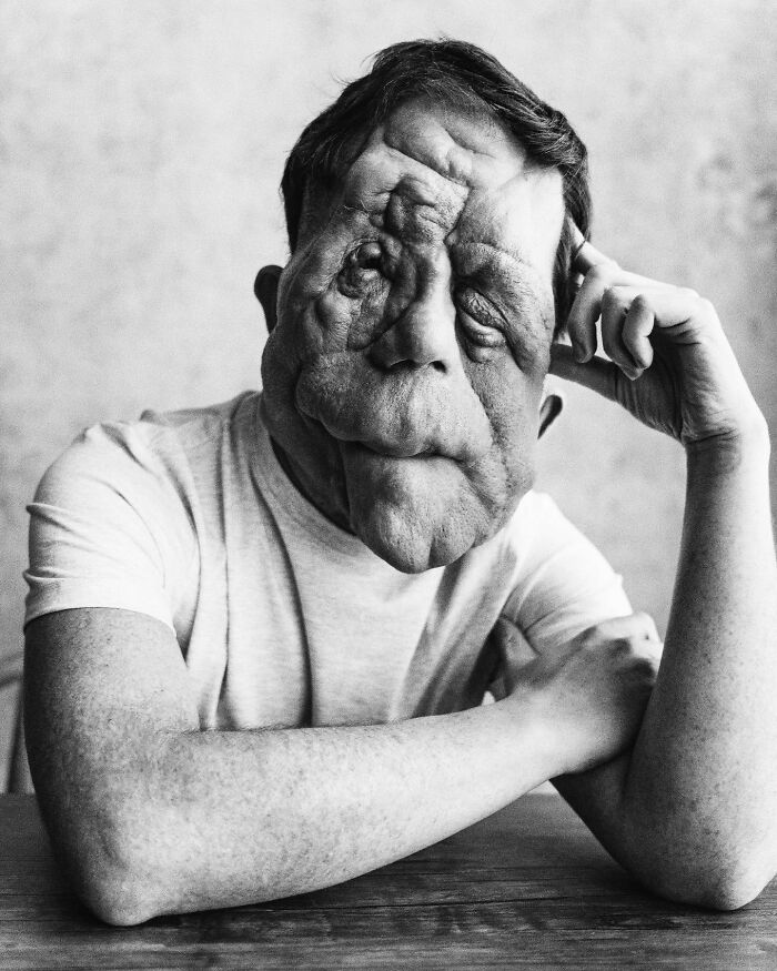 “My Disability Has Opened Doors”: Actor Adam Pearson Wants To Normalize Facial Disfigurement “My Disability Has Opened Doors”: Actor Adam Pearson Wants To Normalize Facial Disfigurement