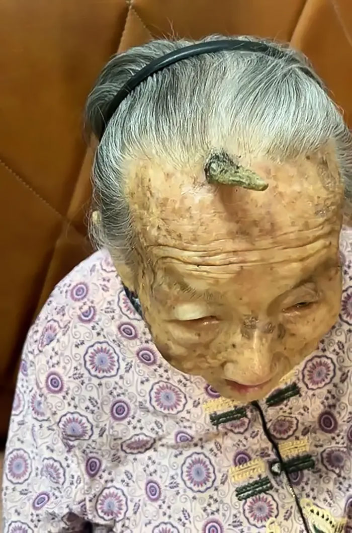 "It's Too Risky": 107YO Goes Viral For 4-Inch "Longevity Horn" Growing From Her Forehead "It's Too Risky": 107YO Goes Viral For 4-Inch "Longevity Horn" Growing From Her Forehead