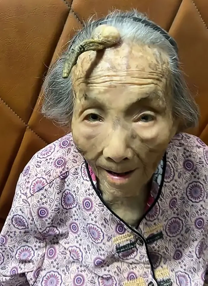 "It's Too Risky": 107YO Goes Viral For 4-Inch "Longevity Horn" Growing From Her Forehead "It's Too Risky": 107YO Goes Viral For 4-Inch "Longevity Horn" Growing From Her Forehead