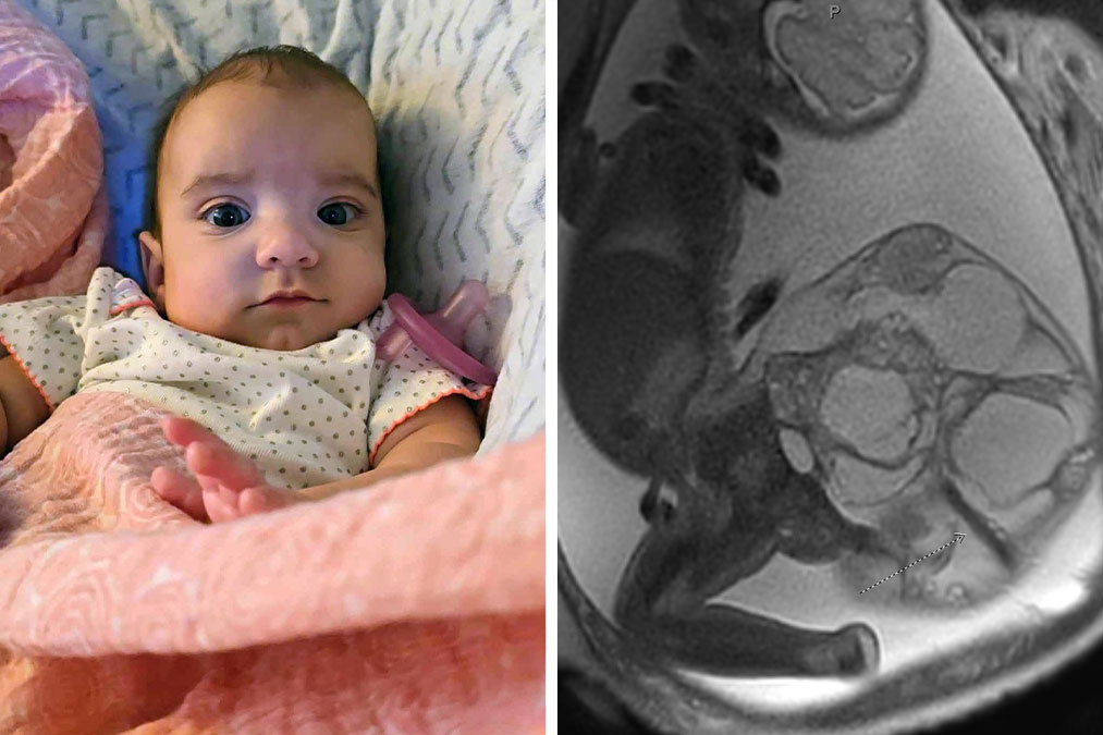 “Miracle Angel”: Newborn Survives Life-Threatening 4-Lb. Tumor, Mom Candidly Shares Her Story
