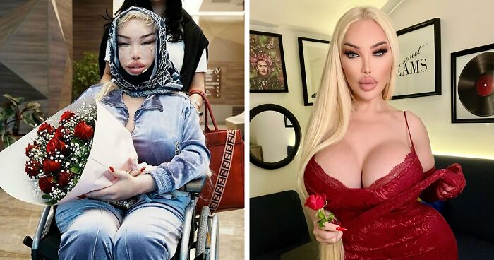 Jessica Alves Covered In Bandages After Fifth Facelift: “3 Or 4 Inches [Of Skin] Would Come Off”